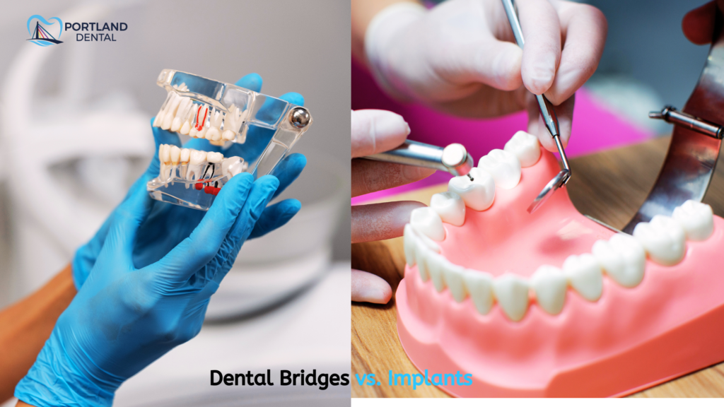 Dental Bridges vs. Implants: Which is Right for You?