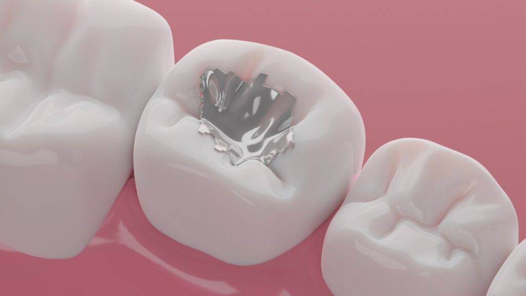 Composite Dental Fillings