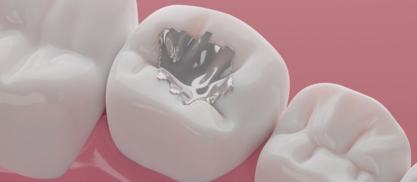 Composite Dental Fillings