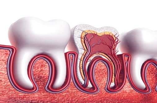 Root Canal