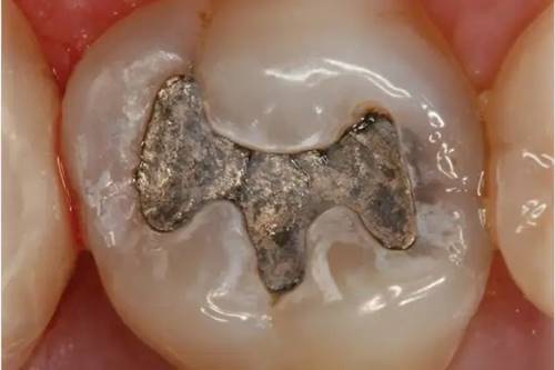 Composite Dental Fillings