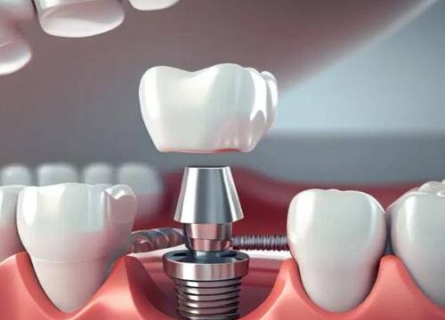 Dental Implants Painful