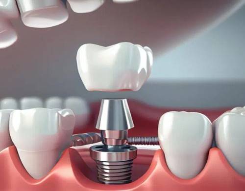Dental Implants Painful
